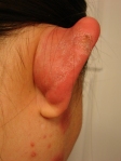 Lupus inflamed ear